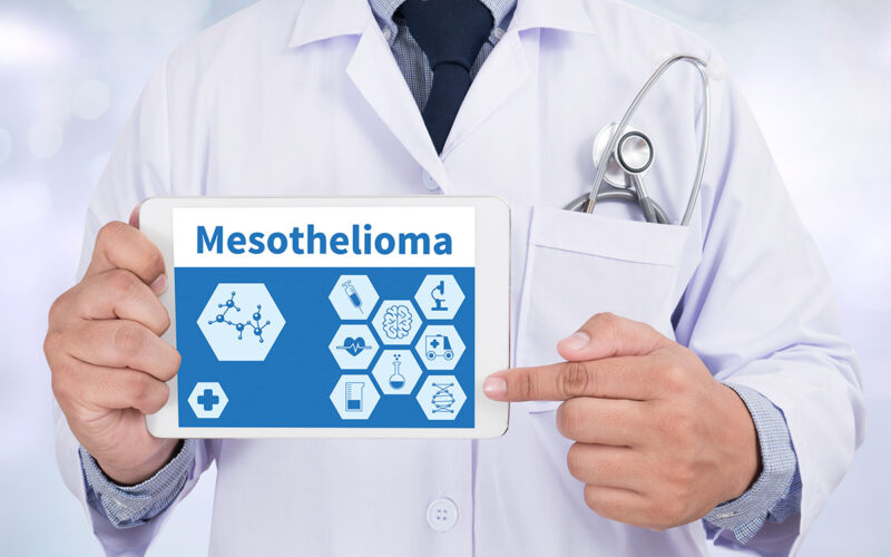 A Guide to Mesothelioma Symptoms and Treatments